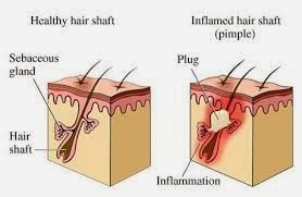 Obat Jerawat Tradisional