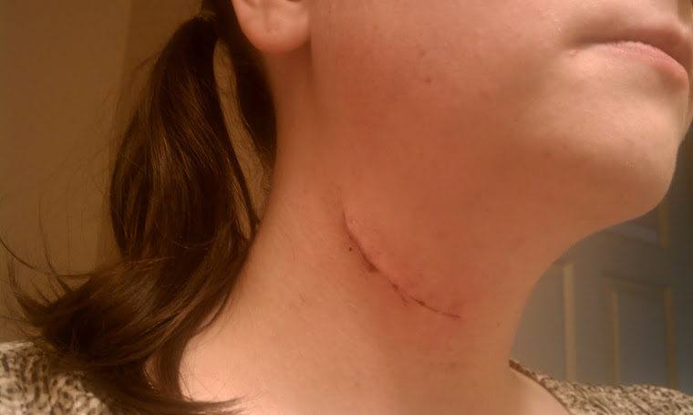 My incision 8 days post op.