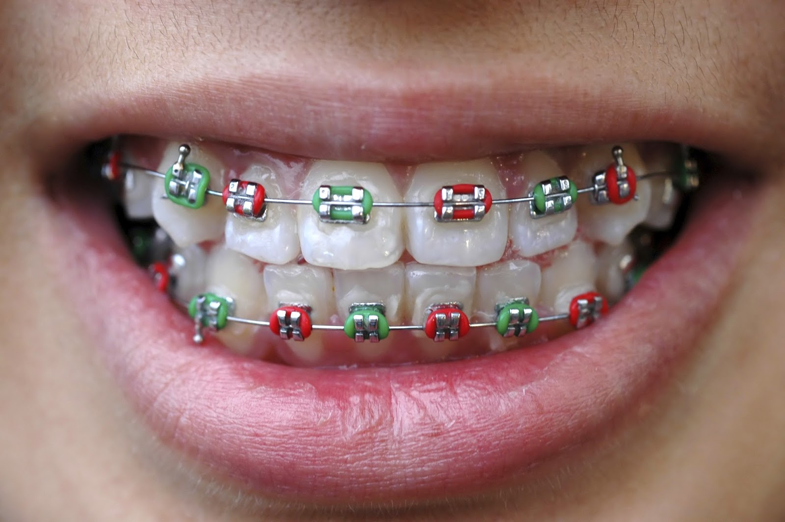 braces for black tie