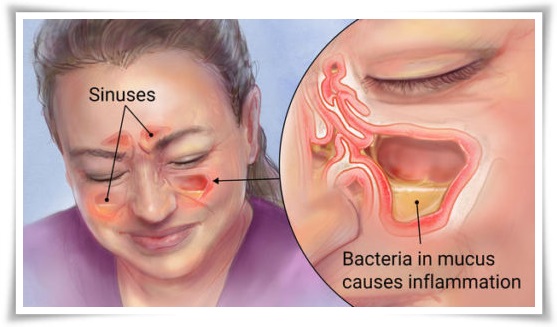 Cara Mengobati Sinusitis Secara Alami Sampai Sembuh Total Cara Mengobati Sinusitis Secara Alami