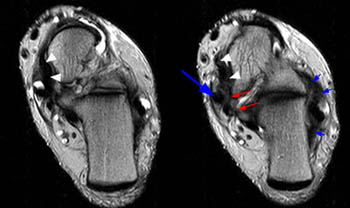 MRI Musculo-Skeletal Section: Spring complex ligament.