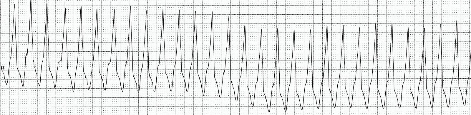 Float Nurse: ECG Rhyth...