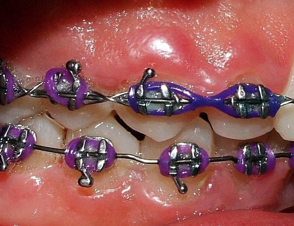 Periodontal problems associated with orthodontic treatment