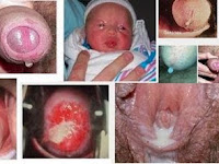 Obat Gonore (Kencing Nanah) Jakarta