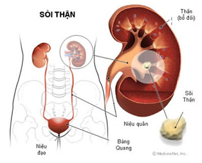 Biểu hiện của sỏi thận