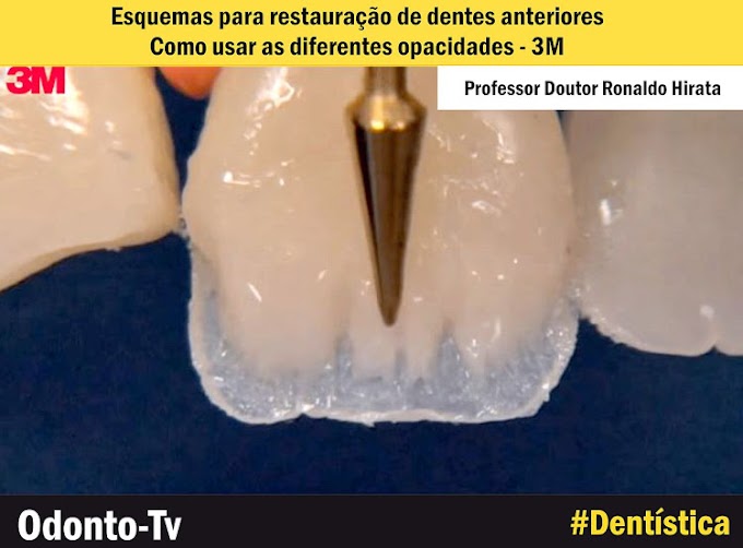 RESINA COMPOSTA: Esquemas para restauração de dentes anteriores: como usar as diferentes opacidades - 3M