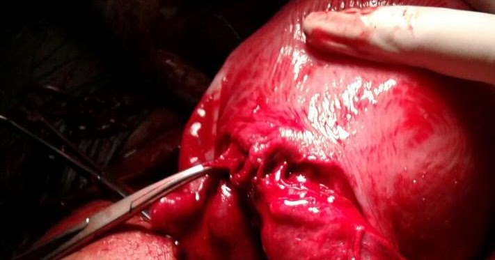 Journal of Postgraduate Gynecology & Obstetrics: Atypical Posterior