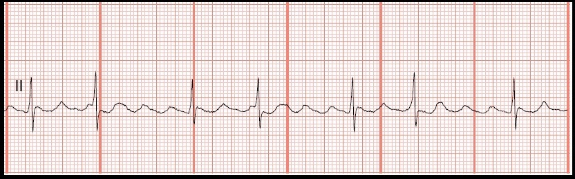 EKG Rhythm Strip Quiz 134