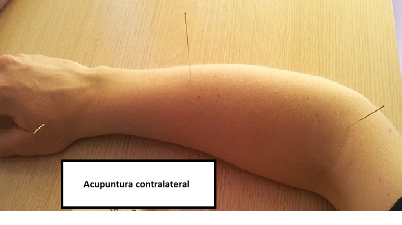 Acupuntura contralateral: el antebrazo afectado es el izquierdo pero se trata a través del derecho