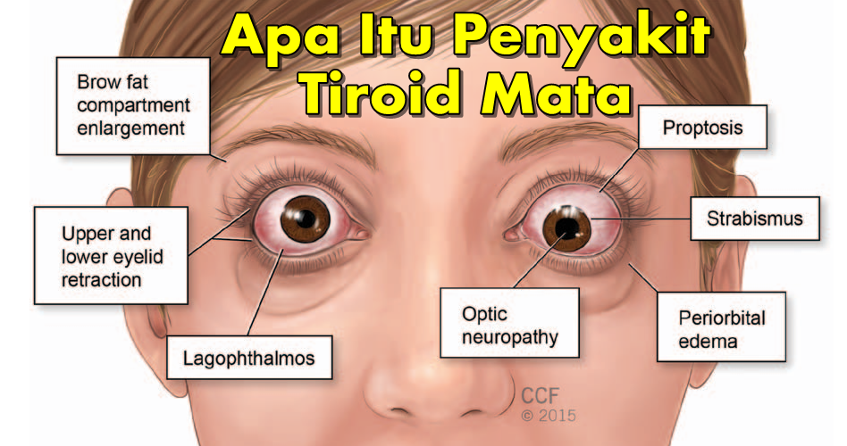 ilustrasi penyakit tiroid mata