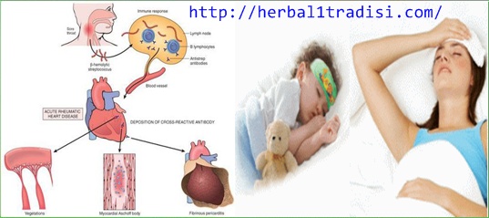 Cara Mengobati Demam Reumatik Herbal Tradisi