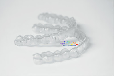 Ortodontide Telsiz Tedavi - Şeffaf Plaklar