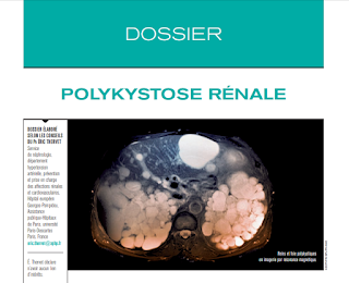 Dossier : Polykystose Rénale 33995711_1953870557970833_7542717588371931136_n
