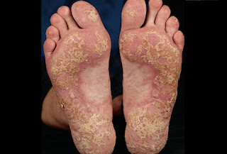 Eksim Dermatitis Psoriasis 