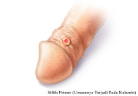 Obat Sakit Sipilis Tradisional Aman dan Terpercaya