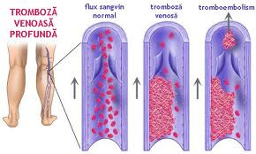pregatiri în vene varicoase ale extremitailor inferioare varicoza pe picioarele dietei