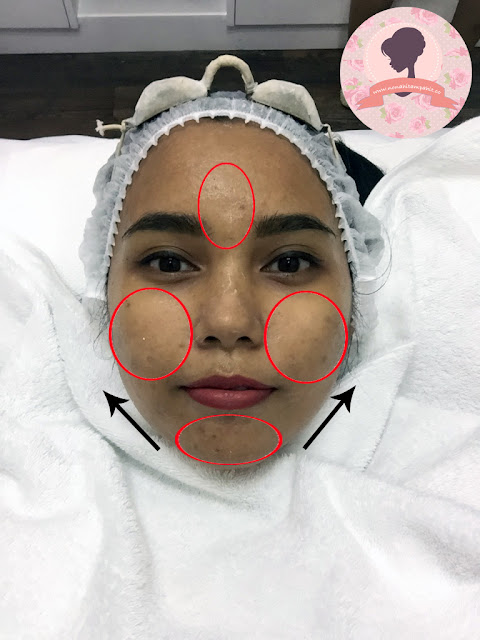 Before-treatment-PPP-Laser-Clinic