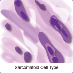 Sarcomatoid cells