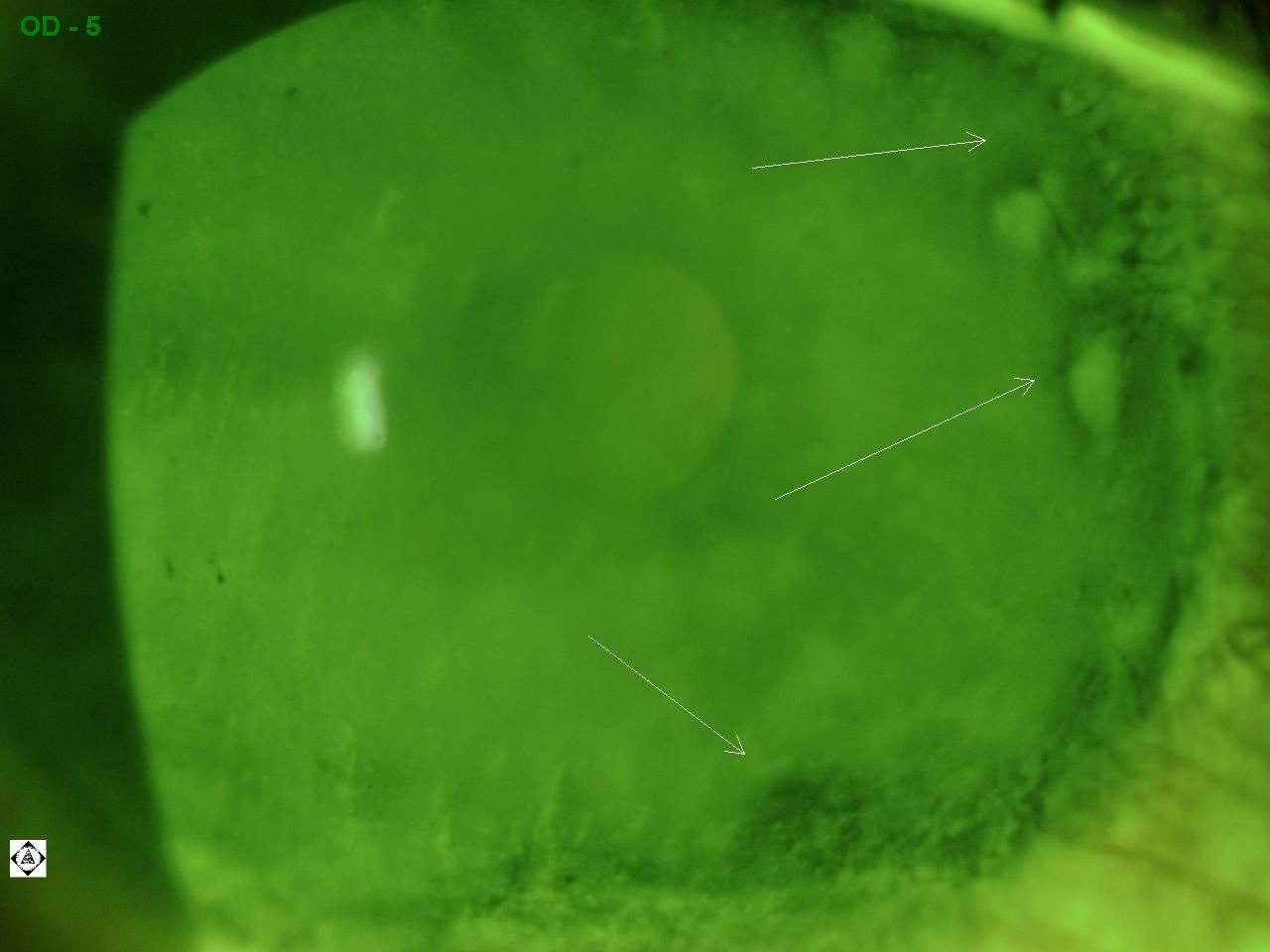 Sonoran Desert Eye Center CONTACT LENS RELATED CORNEAL DAMAGE