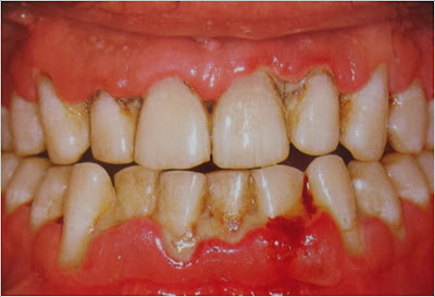 Fonte: http://3.bp.blogspot.com/-M6fRfyhfdB4/ThI-dKBUw9I/AAAAAAAABA4/W8MpvYraidE/s1600/periodontite.jpg