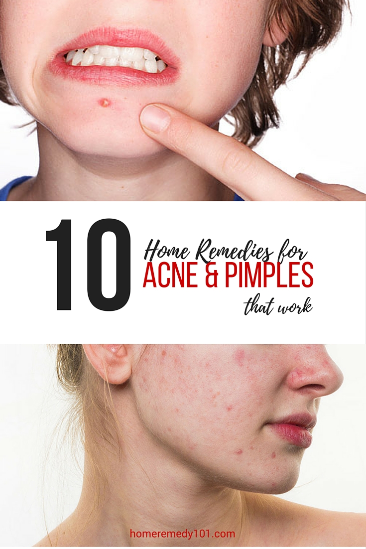 Natural Acne Remedies You Can Use for Your Face and Body