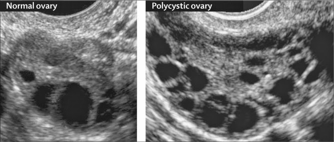 Normal Ovary vs Polycystic Ovary - PCOS