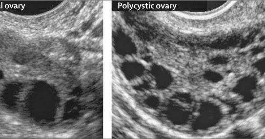 Survivor: Polycystic Ovarian Syndrome (PCOS)