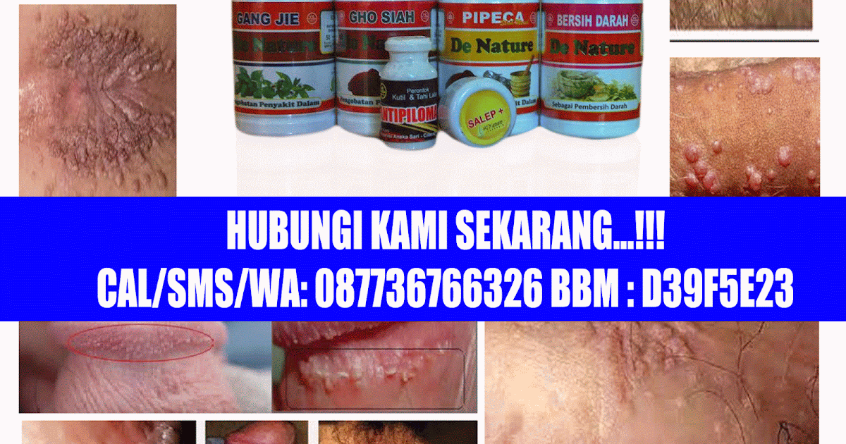 Penyakit Kulit Kutil ~ Berita Pada Kawan-Kawan