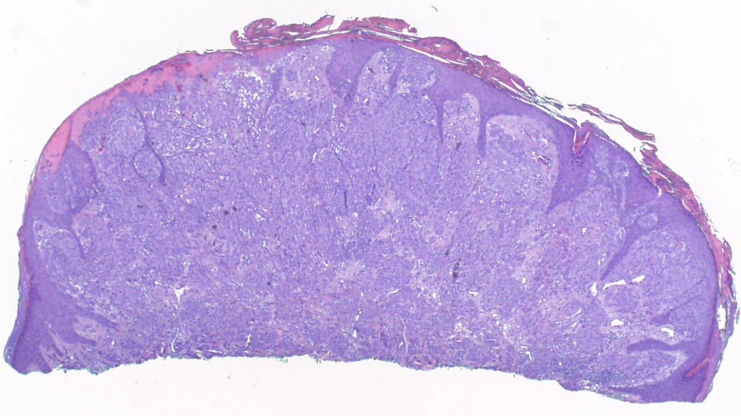Virtual grand rounds in dermatology 2 0 atypical spitz nevus