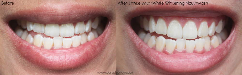 Instant Teeth Whitening Review : Roanna Tan Paradeoflove