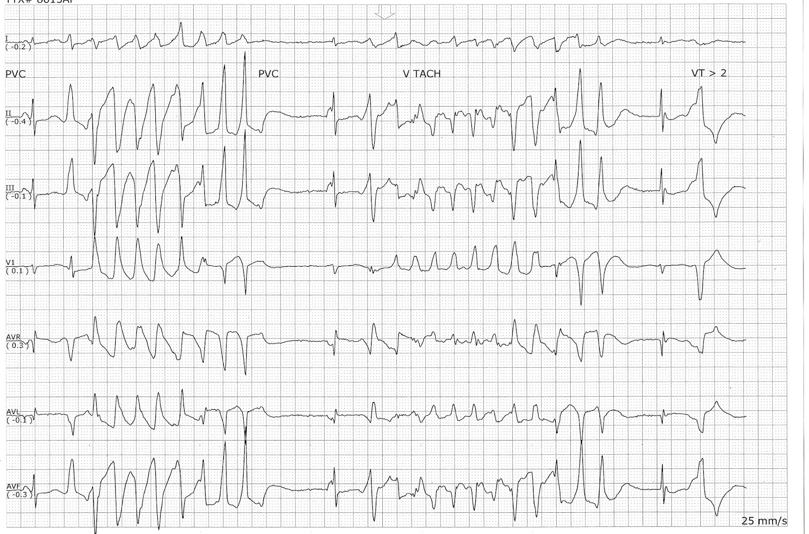 Polymorphic Ventricular Tachycardia Causes