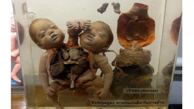 Ngeri!! Rumah Sakit di Thailand ini Pamerkan Bayi-bayi Mati dengan Tubuh Terbelah