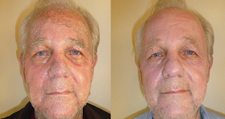 before and afters wrinkles amazing 