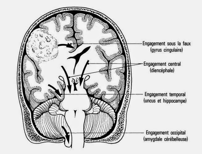 Hipertensión intracrânienne l