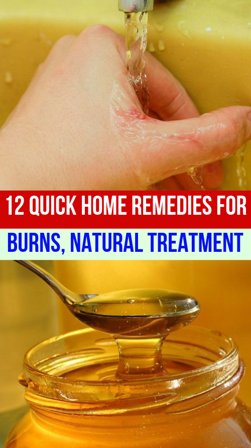 12 Quick Home Remedies For Burns, Natural Treatment webshealth