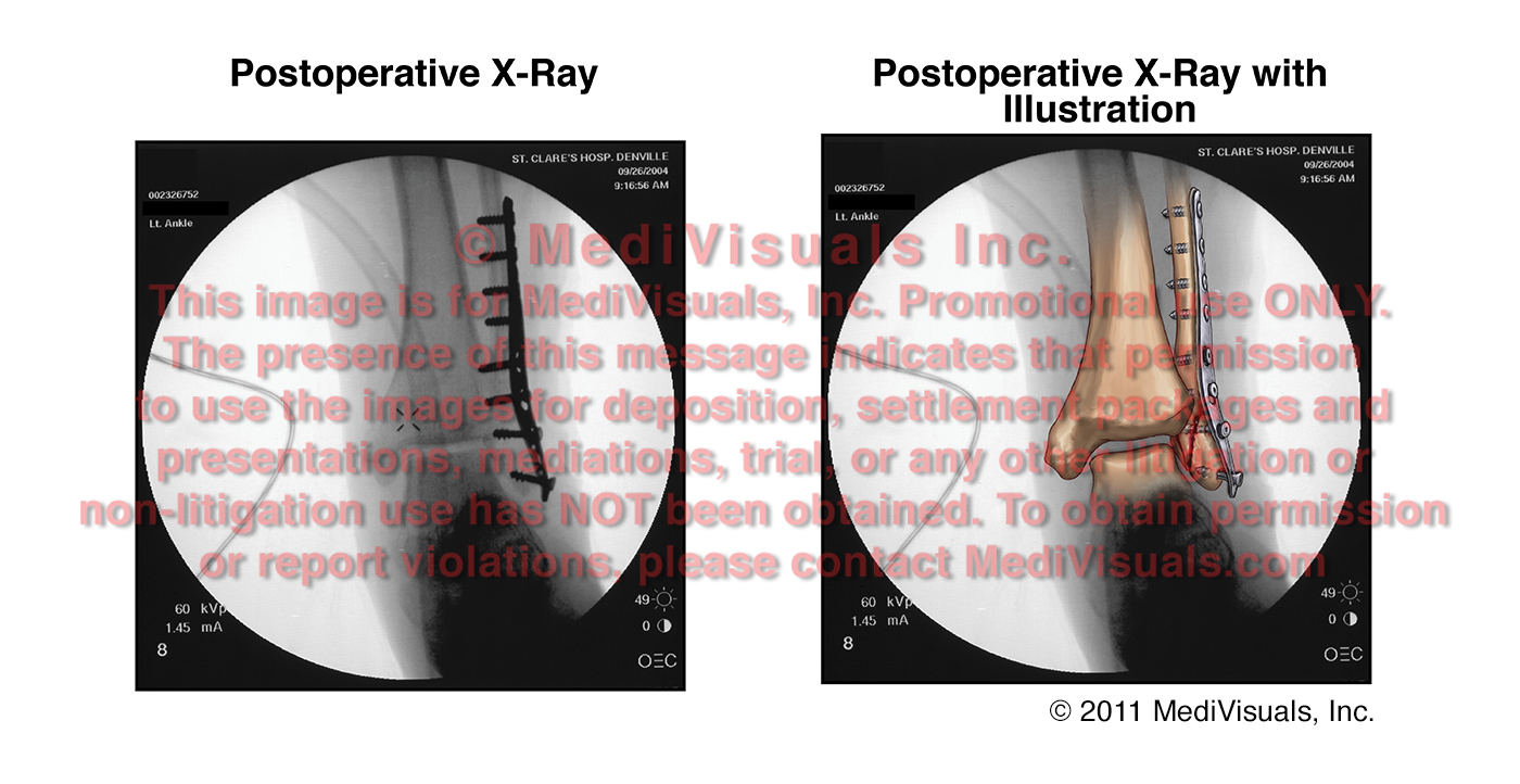 The Medical Legal Exhibit Expert Blog: Intra-operative Trauma: The ...