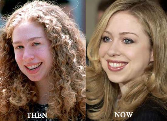 chelsea clinton plastic surgery Image 4