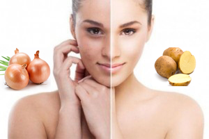 ONION &amp; POTATO FOR DARK SPOTS, ACNE SCARS, DARK EYE CIRCLES, UNDERARMS 
