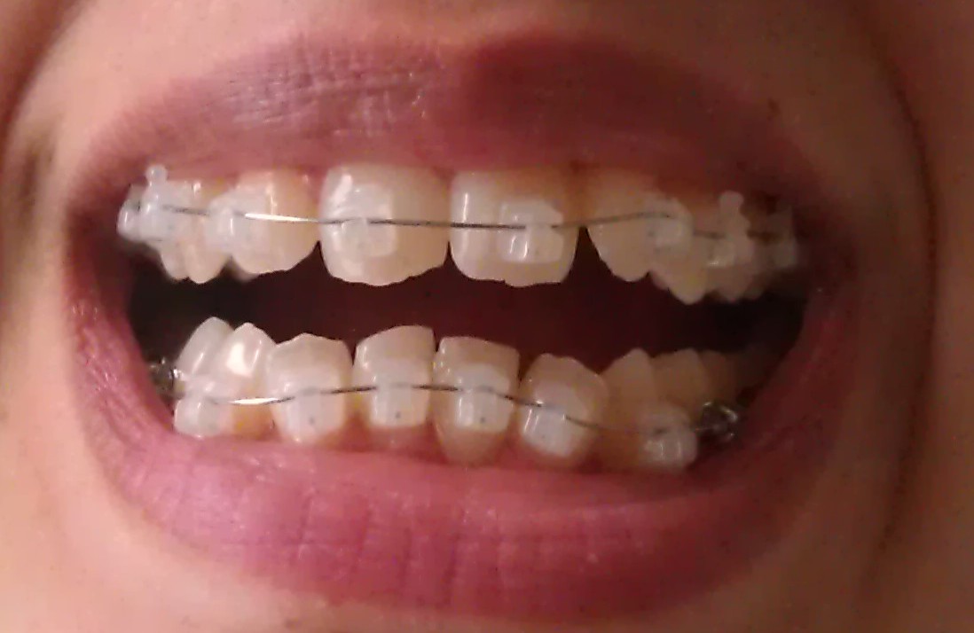 My Damon Clear Braces Day 21 first wire change!!