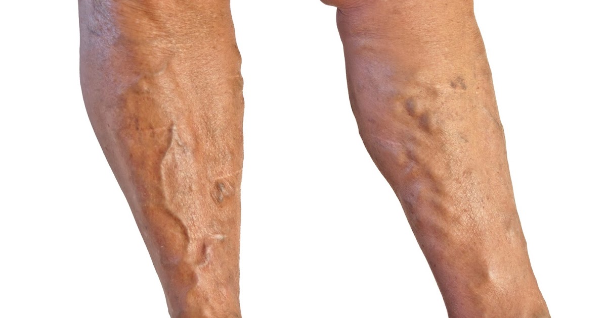 Natural Treatment For Varicose Veins In Pregnancy Natural Treatment For Varicose Veins In Pregnancy