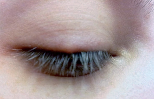 ingrown eyelash