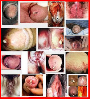 Epidemiologi kencing nanah, obat gonore (kemaluan keluar nanah) propolis, sifilis adalah pdf, obat sipilis jogja, obat untuk mengobati gonore, stadium sifilis, obat kencing nanah semarang, obat gonore (kemaluan keluar nanah) jogja, hilangkan sipilis, apa bahaya penyakit gonore, mengobati kemaluan keluar nanah