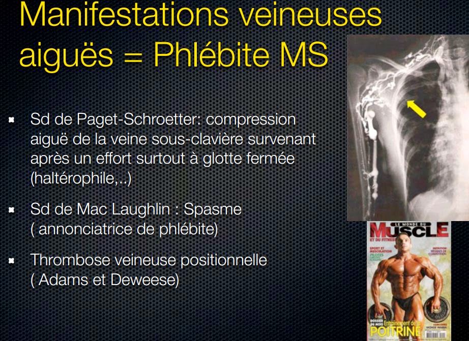 Un médecin du sport vous informe Syndrome du défilé thoracobrachial (SDTB)