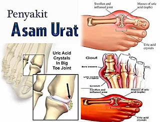 www.obat tradisional asam urat.com, cara mengobati asam urat paling ampuh, tanaman obat utk penyakit asam urat, mengobati asam urat cepat, asam urat makan kambing, askep dengan asam urat, asam urat english, obat asam urat yang sudah akut, obat penyembuhan penyakit asam urat, obat asam urat kolesterol dan diabetes, cara mengobati asam urat pada kaki secara alami, gambar terkena asam urat, larangan makanan bagi penderita asam urat dan kolesterol, asam urat rendah adalah, apa itu asam urat dan penyebabnya, obat asam urat yang sudah kronis, mengobati kaki bengkak akibat asam urat, nilai normal asam urat kolesterol gula darah, cara menyembuhkan asam urat pada tangan, resep obat asam urat secara alami, cara menurunkan asam urat herbal, asam urat makan wortel, asam urat gout artritis, kadar asam urat normal pada anak, obat untuk penderita asam urat dan kolesterol, cara mengobati asam urat yang alami, foto kaki asam urat, perbedaan gejala asam urat dan rematik, cara menurunkan asam urat pd ibu hamil, apakah penyakit asam urat itu berbahaya 