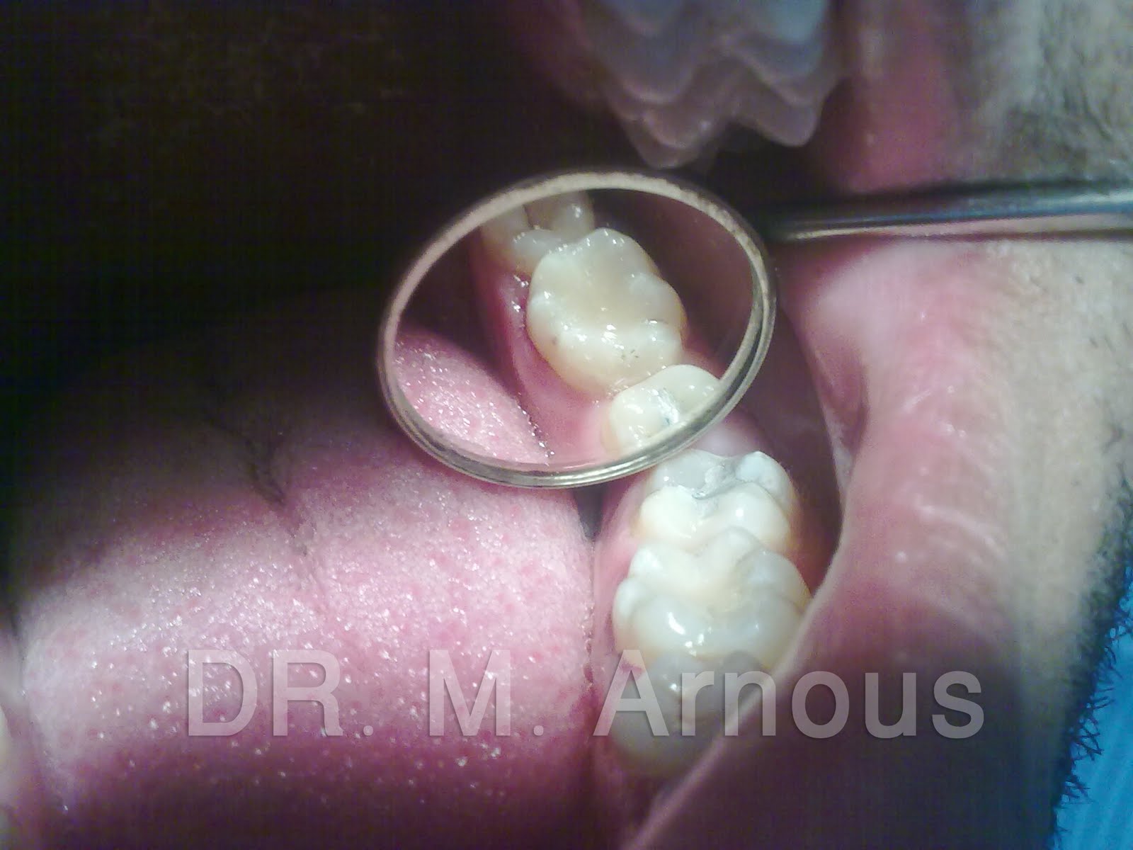 DR. Mohammed Arnous Class I Amalgam Restoration + Class I Composite