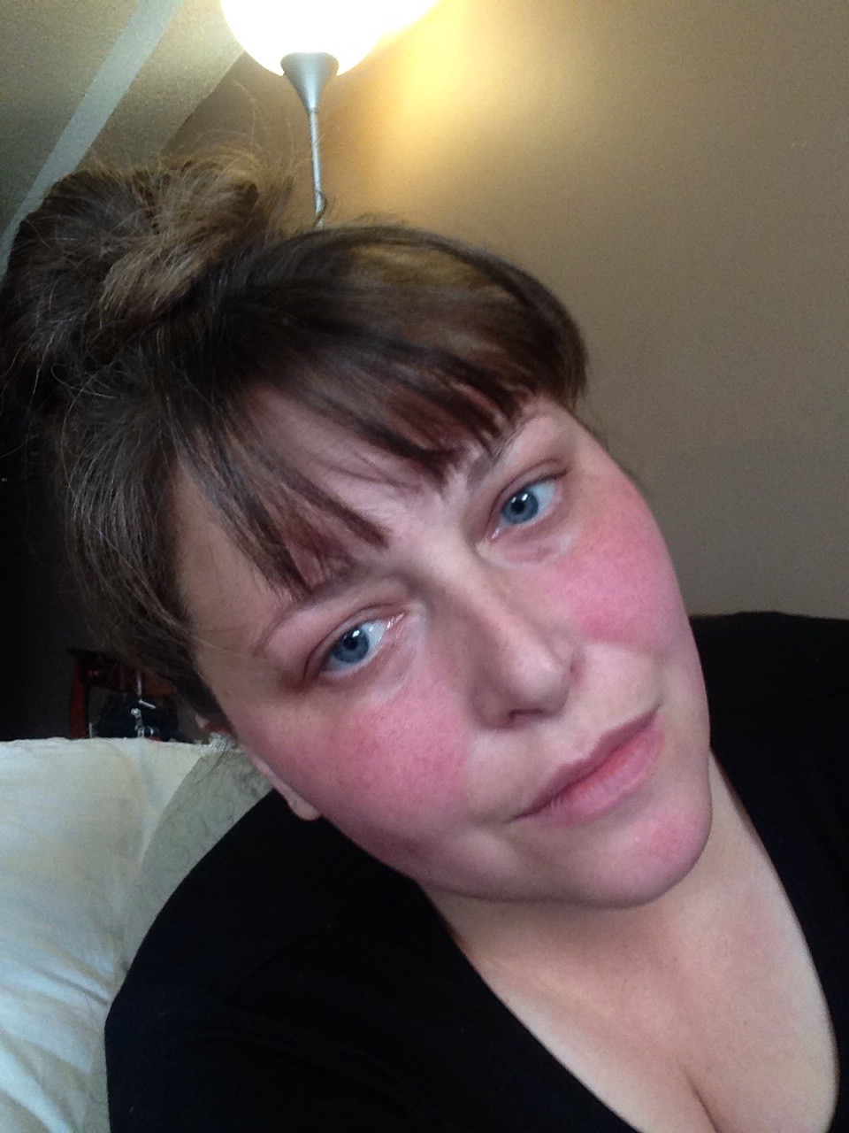 Scarlet Letters, dealing with vascular rosacea, face flushing, burning