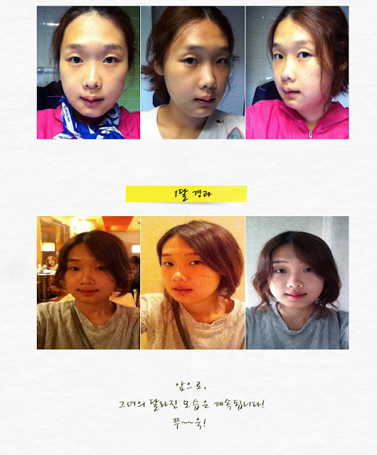 ID Hospital Korea how much is korea plastic surgery, two jaw surgery