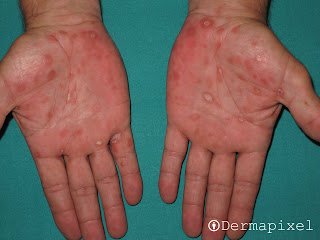 Resultado de imagen de clavos sifiliticos manos