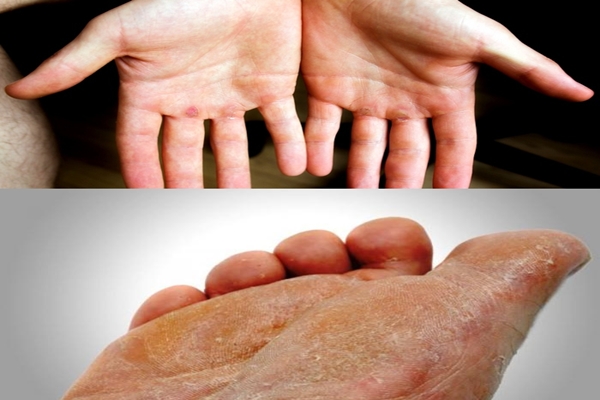 APAKAH TANGAN DAN KAKI ANDA KAPALAN? JANGAN KHAWATIR ...