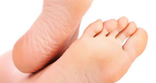 6 Penyebab Tumit Kaki Pecah Pecah dan Cara mengatasinya 6 Penyebab Tumit Kaki Pecah Pecah dan Cara mengatasinya